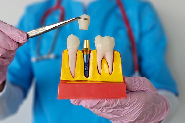 How A Surgical Dental Implant Fuses With  Jawbone