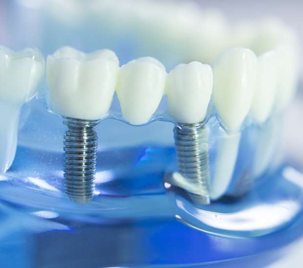 Beverly Hills Dental Implants
