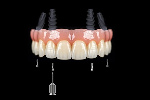 How Many Implants Are Needed For Lower Implant Supported Dentures?