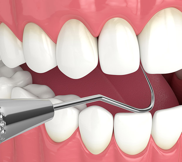 Beverly Hills Interactive Periodontal Probing