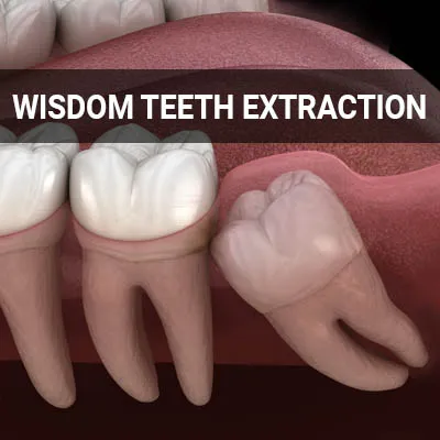Visit our Wisdom Teeth Extraction page